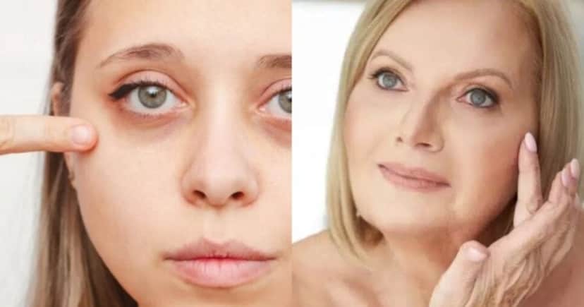 Fim das olheiras veja Ingrediente secreto que dá fim ao problema Fim das olheiras veja Ingrediente secreto que dá fim ao problema