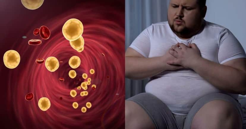 5 sintomas que indicam colesterol alto - Foto Reprodução Internet 5 sintomas que indicam colesterol alto - Foto Reprodução Internet