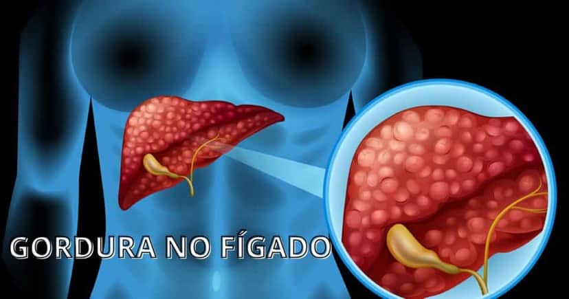A gordura no fígado é uma das doenças que mais afetam a saúde do corpo (Foto Reprodução/Montagem/Tv Foco) A gordura no fígado é uma das doenças que mais afetam a saúde do corpo (Foto Reprodução/Montagem/Tv Foco)