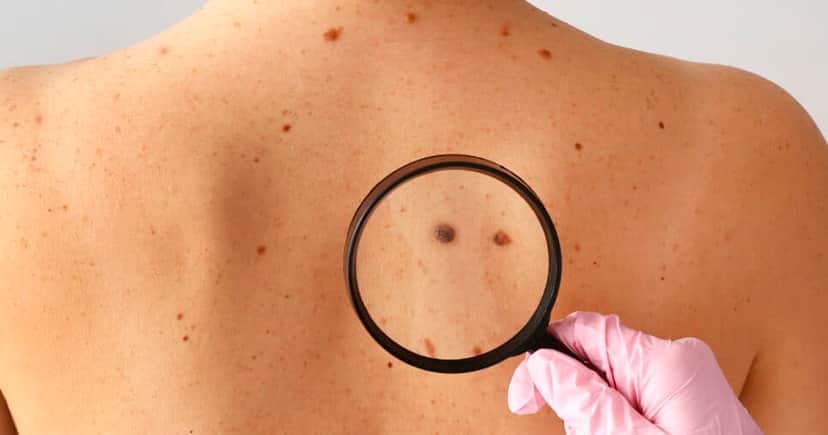 Tipo de Câncer de pele (Foto: Reprodução) Tipo de Câncer de pele (Foto: Reprodução)