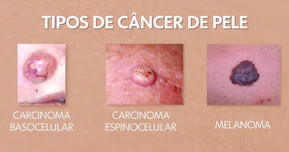 Tipos de Câncer de pele (Foto: Reprodução) Tipos de Câncer de pele (Foto: Reprodução)