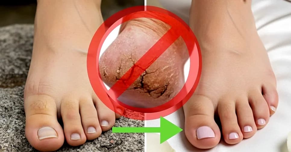 Pé de princesa: Creme caseiro, com 4 ingredientes, ajuda a remover os calos e alivia o desconforto