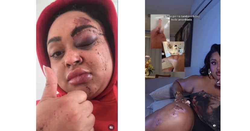 Rízia Cerqueira, ex-participante do BBB, mostra como ficou após acidente (Foto: Reprodução / Instagram) Rízia Cerqueira, ex-participante do BBB, mostra como ficou após acidente (Foto: Reprodução / Instagram)