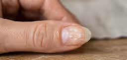 Unhas com manchas brancas: Quais são as causas e como fazer para tratar