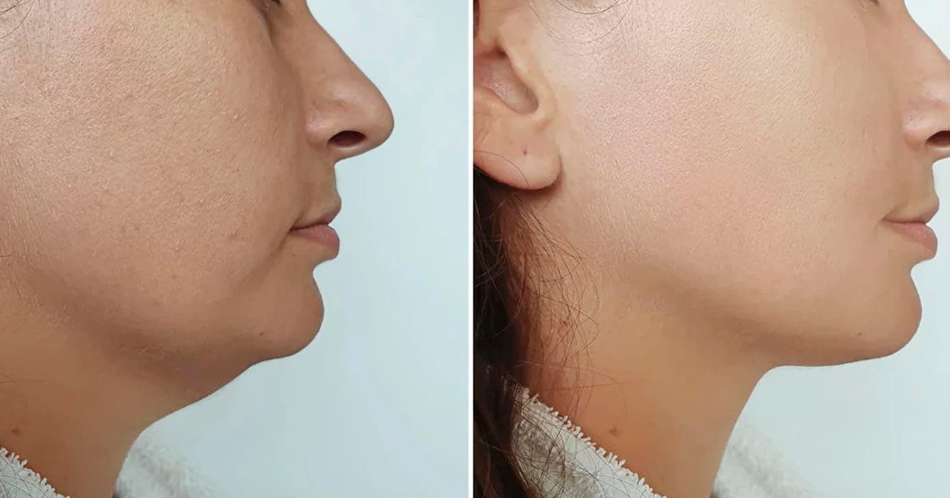 Antes e depois de um rosto inchado (Foto: Reprodução) Antes e depois de um rosto inchado (Foto: Reprodução)
