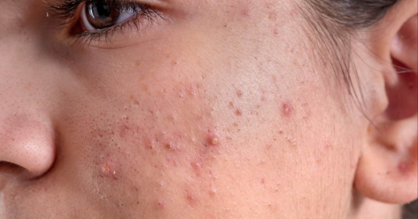 Adeus às espinhas: Tratamento natural caseiro com 1 ingrediente reduz a acne e deixa a pele mais bonita