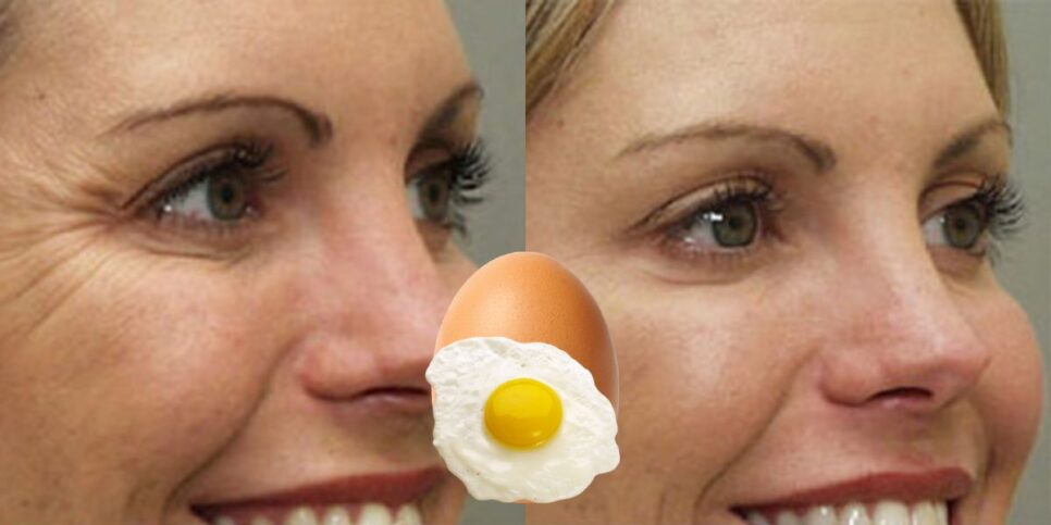Um botox caseiro com ovo traz resultados melhores que harmonização (Reprodução: Montagem TV Foco)
